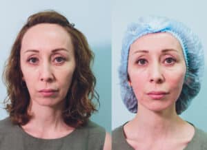 Facelift procedure using PDO threading technique with PDO threads visible before and after.