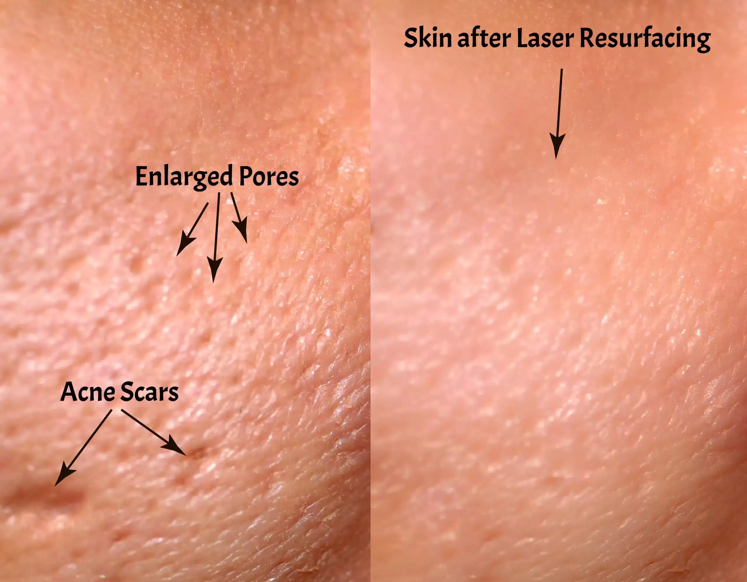 Fractional Laser Rejuvenation Resurfacing