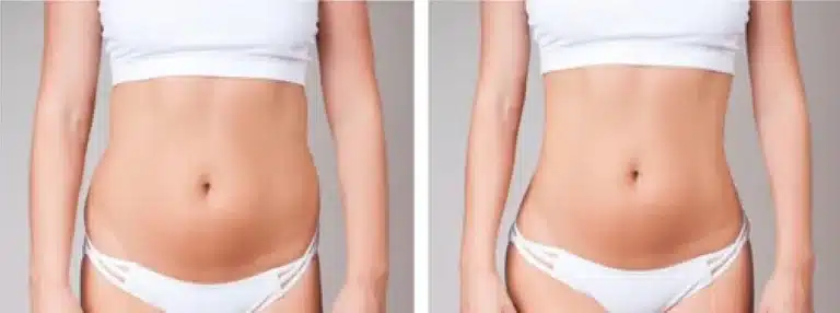 Semaglutide-Ozempic, Weight Loss, body sculpting, RF, Microneedling, Semaglutide, Ozempic, Wegovy and Rybelsus, RF Microneedling
