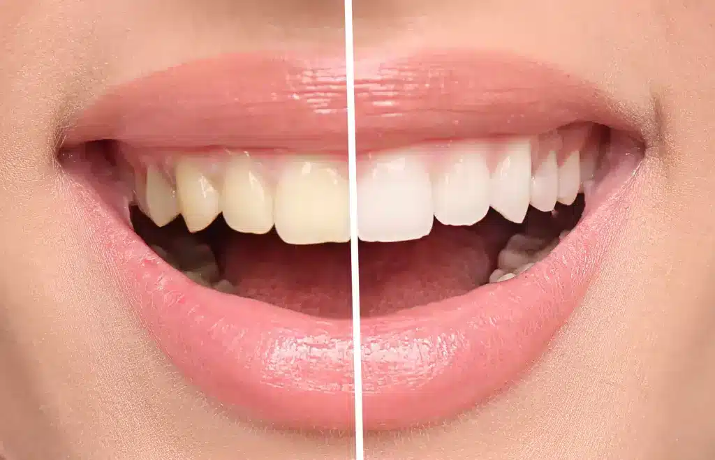 Teeth whitening and lip fillers at Genesis Spa MD